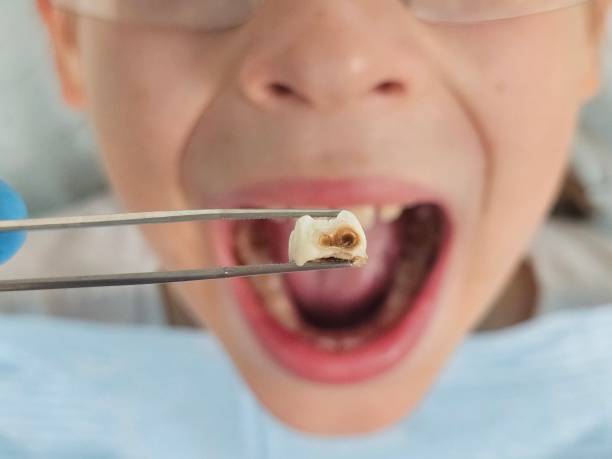 Best Emergency Treatment for Dental Infections or Abscesses in Fordoche, LA